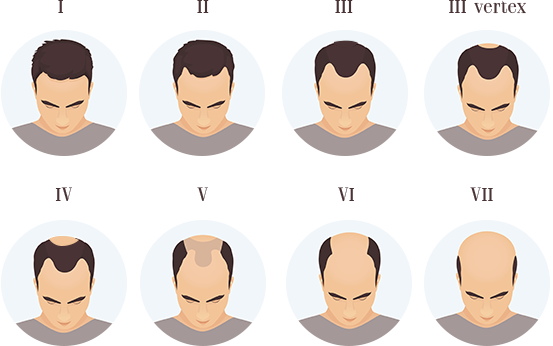 Hair loss quiz