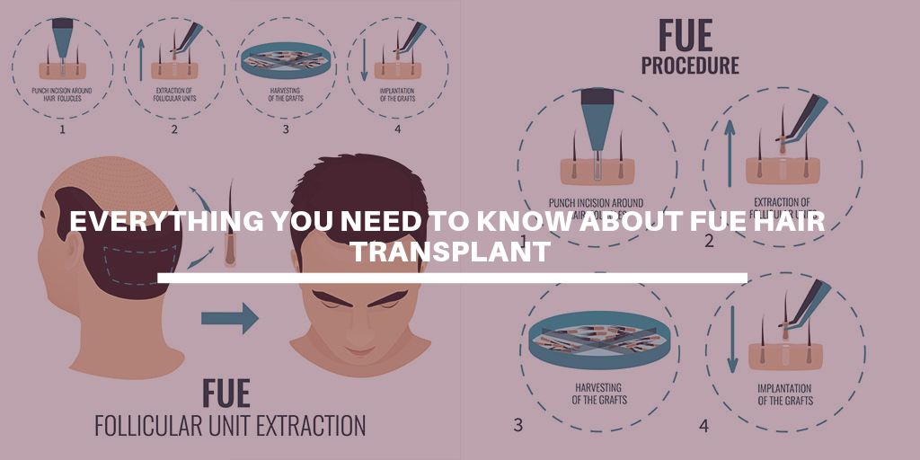 Everything you need to know about FUE Hair Transplant